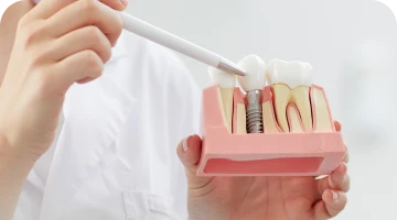 Explicação de como funciona um implante dentário
