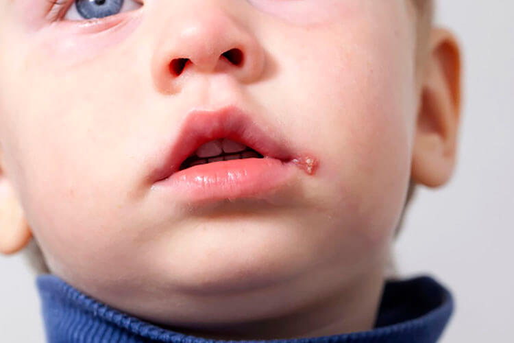 Herpes infantil: Quais são os riscos?