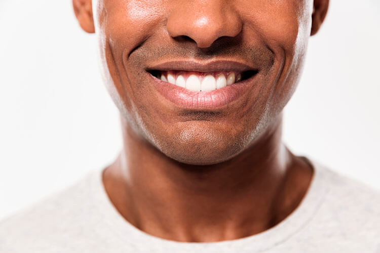 A cor dos dentes e o sorriso. Clarear ou não?