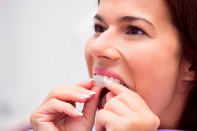 Saiba as vantagens que o Invisalign proporciona