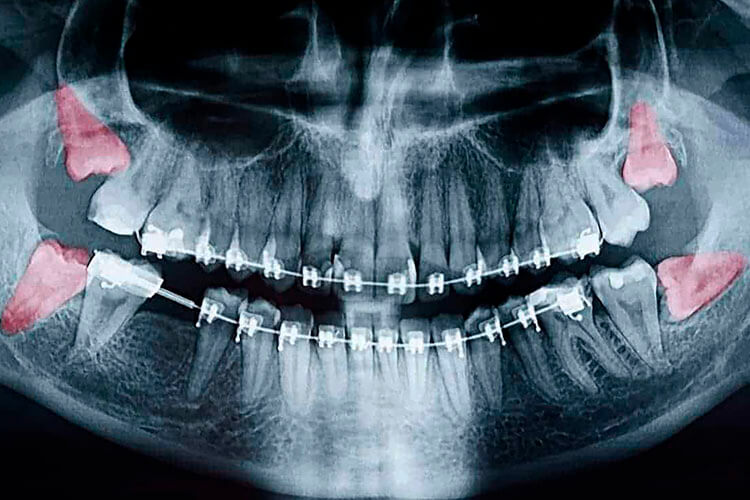 O SISO, dente do juízo ou terceiro molar. Saiba mais!