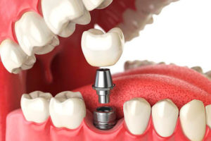 implante dentário dental tratamento implantodontia