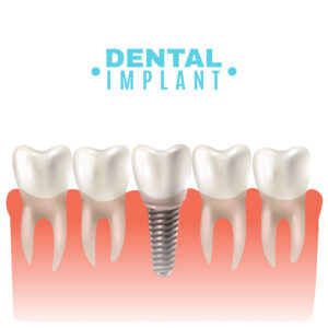 implante dentário dental fixado no osso entre os dentes verdadeiros